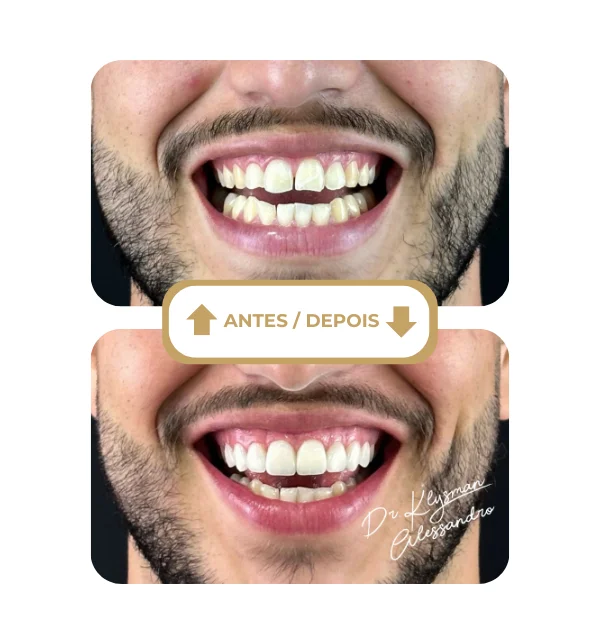 Resultado antes e depois 2